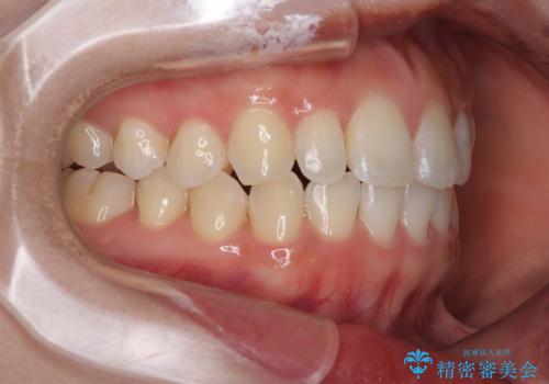 目立ちにくい表側装置で1年完了!狭いアーチを側方拡大し前歯のデコボコを整えた症例の治療後