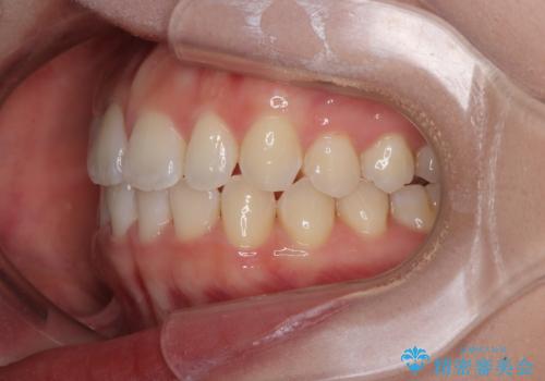 目立ちにくい表側装置で1年完了!狭いアーチを側方拡大し前歯のデコボコを整えた症例の治療後