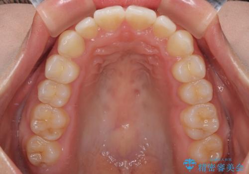 目立ちにくい表側装置で1年完了!狭いアーチを側方拡大し前歯のデコボコを整えた症例の治療後