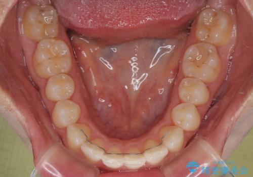 目立ちにくい表側装置で1年完了!狭いアーチを側方拡大し前歯のデコボコを整えた症例の治療後