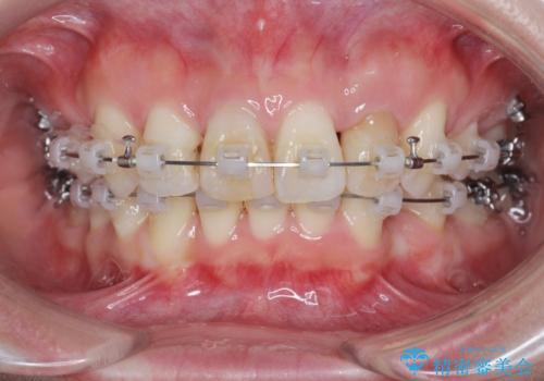 がたつきと出っ歯 ワイヤー矯正での歯並び改善の治療中