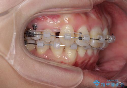 がたつきと出っ歯 ワイヤー矯正での歯並び改善の治療中