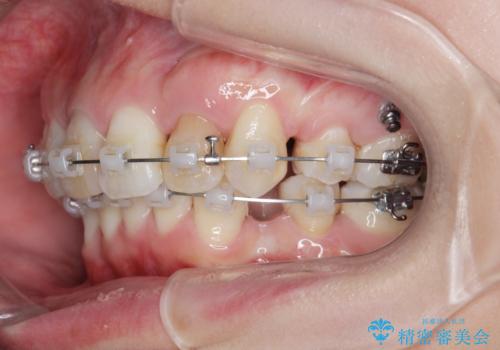 がたつきと出っ歯 ワイヤー矯正での歯並び改善の治療中
