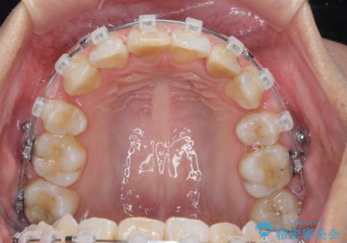 がたつきと出っ歯 ワイヤー矯正での歯並び改善の治療中