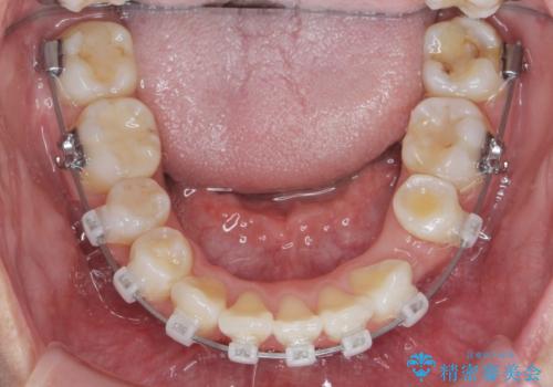がたつきと出っ歯 ワイヤー矯正での歯並び改善の治療中