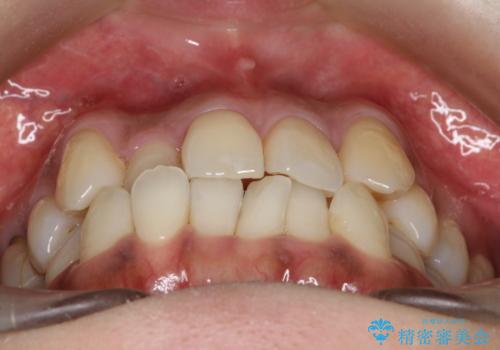 【審美装置】抜歯の本数最小限で行った矯正治療の治療前