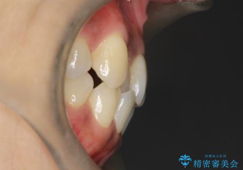 【審美装置】抜歯の本数最小限で行った矯正治療の治療前