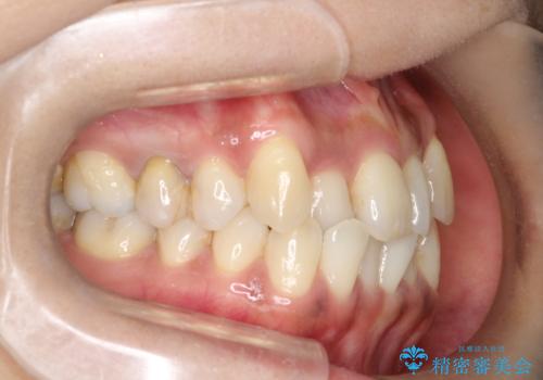 【審美装置】抜歯の本数最小限で行った矯正治療の治療前