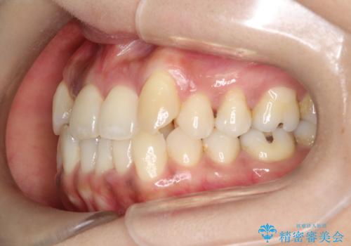 【審美装置】抜歯の本数最小限で行った矯正治療の治療前