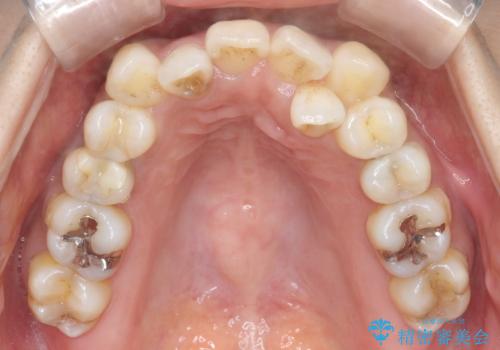 【審美装置】抜歯の本数最小限で行った矯正治療の治療前