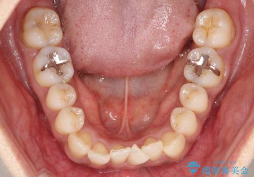 【審美装置】抜歯の本数最小限で行った矯正治療の治療前
