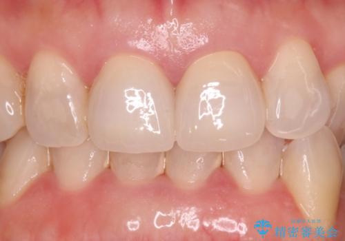 前歯の色が気になる オールセラミッククラウンで綺麗で健康な歯にの治療後