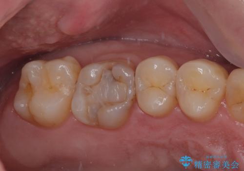 舌で触ると段差が気になる ゴールドインレー修復の治療中