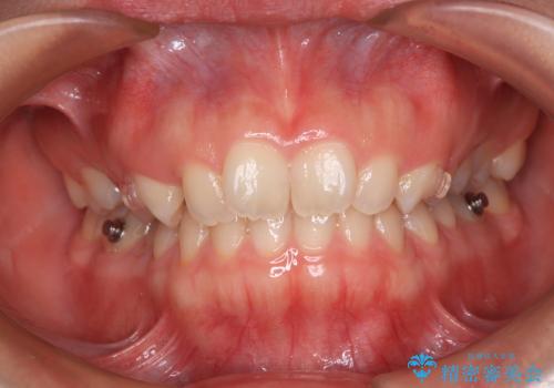 補助装置を併用して確実に インビザラインで奥歯の咬み合わせをしっかりと改善の治療中