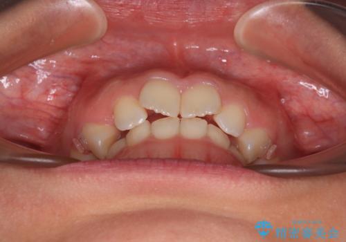 補助装置を併用して確実に インビザラインで奥歯の咬み合わせをしっかりと改善の治療中