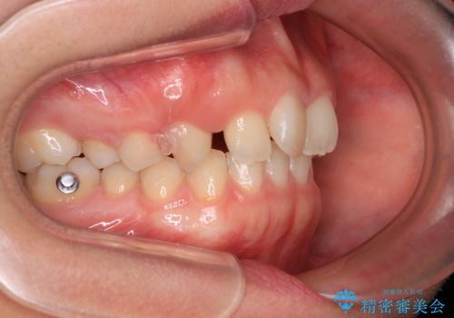 補助装置を併用して確実に インビザラインで奥歯の咬み合わせをしっかりと改善の治療中