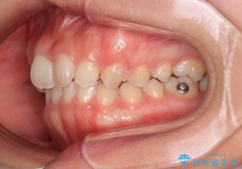 補助装置を併用して確実に インビザラインで奥歯の咬み合わせをしっかりと改善の治療中