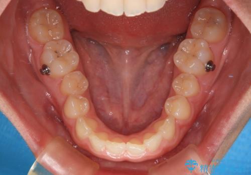 補助装置を併用して確実に インビザラインで奥歯の咬み合わせをしっかりと改善の治療中