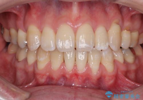 口元の突出感を改善!目立ちにくいワイヤー矯正で自信を持てる自然な横顔にの症例 治療後