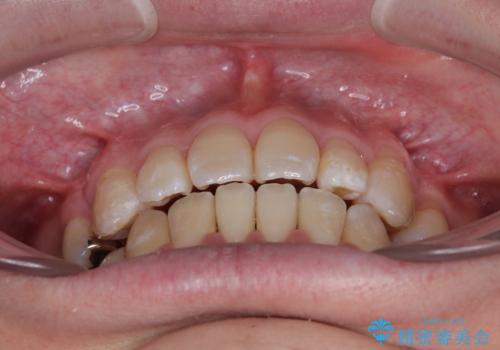 口元の突出感を改善!目立ちにくいワイヤー矯正で自信を持てる自然な横顔にの治療後