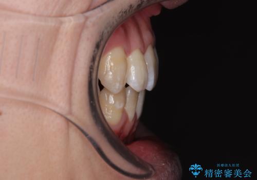 口元の突出感を改善!目立ちにくいワイヤー矯正で自信を持てる自然な横顔にの治療後