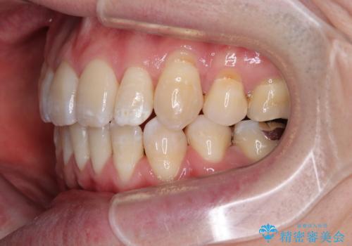 口元の突出感を改善!目立ちにくいワイヤー矯正で自信を持てる自然な横顔にの治療後