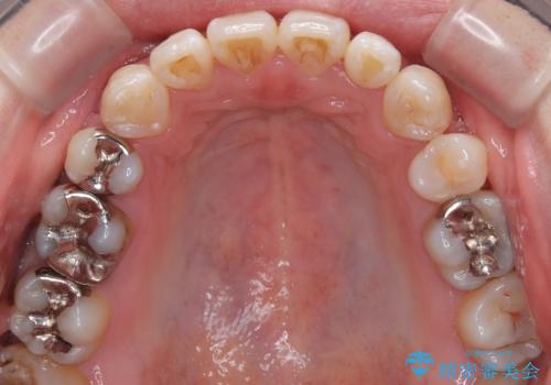 口元の突出感を改善!目立ちにくいワイヤー矯正で自信を持てる自然な横顔にの治療後