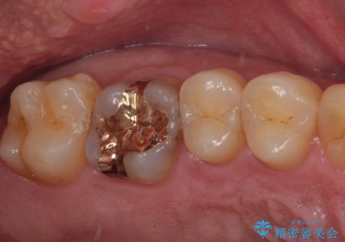 舌で触ると段差が気になる ゴールドインレー修復の症例 治療後
