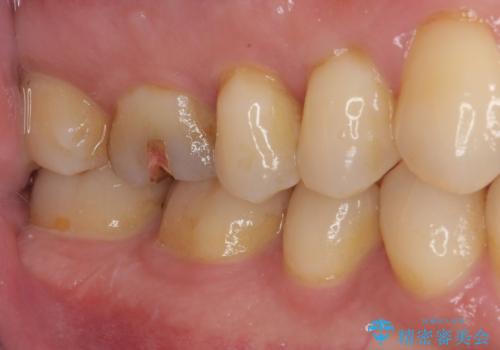 舌で触ると段差が気になる ゴールドインレー修復の治療後