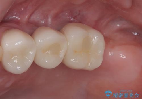 欠損の多い奥歯 インプラントによる補綴治療の治療後