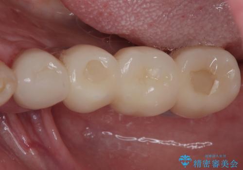 欠損の多い奥歯 インプラントによる補綴治療の治療後
