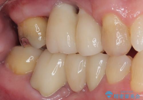 欠損の多い奥歯 インプラントによる補綴治療の治療後