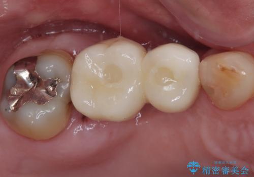 欠損の多い奥歯 インプラントによる補綴治療の治療後