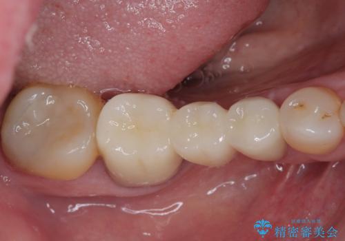 欠損の多い奥歯 インプラントによる補綴治療の治療後