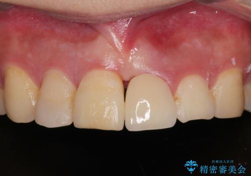転んで折れてしまった前歯 インプラント補綴治療の症例 治療後