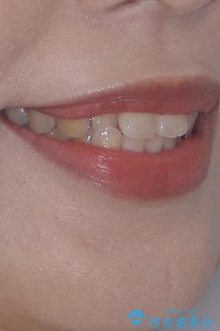 目立ちにくい表側装置で1年完了!狭いアーチを側方拡大し前歯のデコボコを整えた症例の治療前(顔貌)
