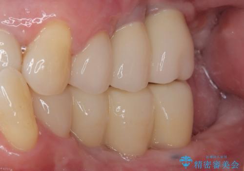 欠損の多い奥歯 インプラントによる補綴治療の症例 治療後