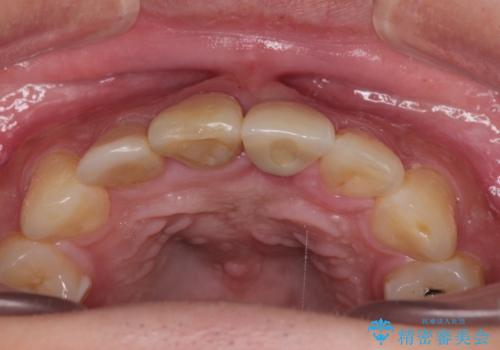 転んで折れてしまった前歯 インプラント補綴治療の治療後