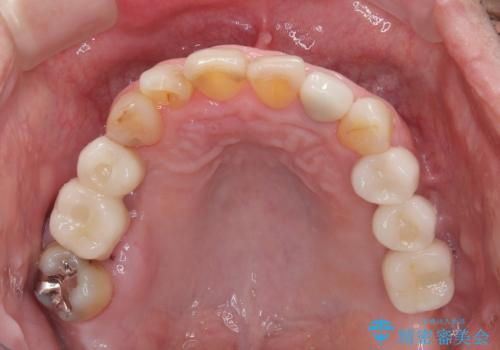 欠損の多い奥歯 インプラントによる補綴治療の治療後