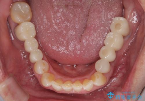 欠損の多い奥歯 インプラントによる補綴治療の治療後
