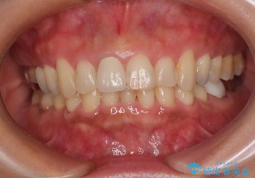 不自然な色彩の前歯 オールセラミッククラウンで自然な口元にの治療後