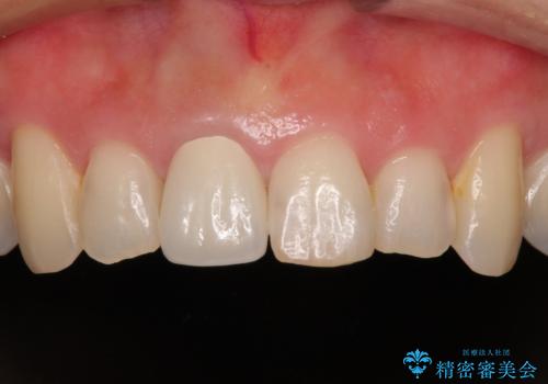 不自然な色彩の前歯 オールセラミッククラウンで自然な口元にの症例 治療後