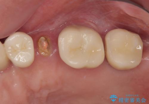 破折によりクラウンの外れてしまった奥歯 抜歯即時埋入で短期間インプラント治療の症例 治療前