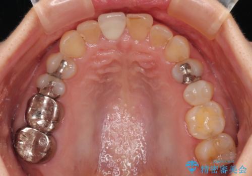 不自然な色彩の前歯 オールセラミッククラウンで自然な口元にの治療後