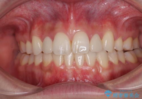 飛び出した前歯 インビザラインを用いた抜歯矯正治療の治療後