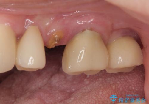 破折によりクラウンの外れてしまった奥歯 抜歯即時埋入で短期間インプラント治療の治療前