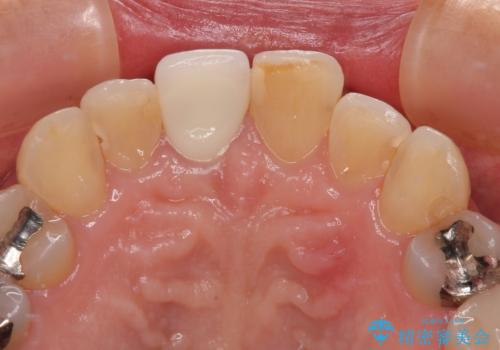 不自然な色彩の前歯 オールセラミッククラウンで自然な口元にの治療後