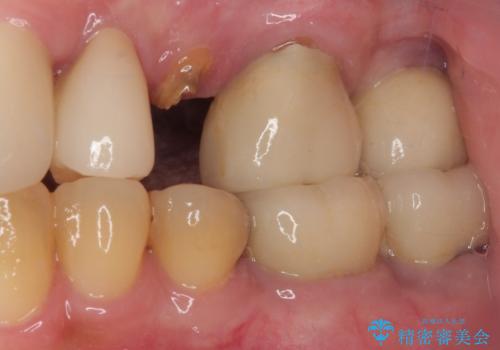 破折によりクラウンの外れてしまった奥歯 抜歯即時埋入で短期間インプラント治療の治療前