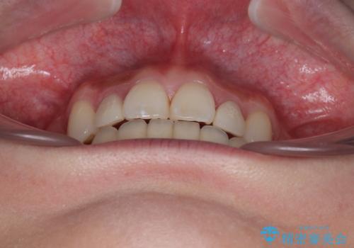 飛び出した前歯 インビザラインを用いた抜歯矯正治療の治療後