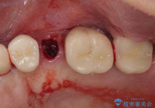 破折によりクラウンの外れてしまった奥歯 抜歯即時埋入で短期間インプラント治療の治療前
